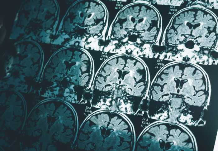 Alzheimer's brain scan