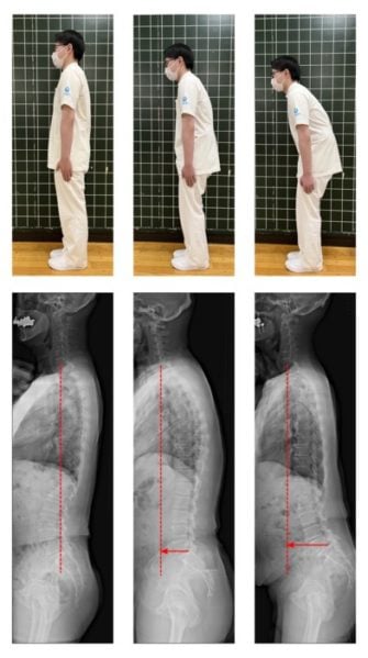 The spinal column posture evaluated by the examination. The left shows the posture in which the anterior-posterior balance of the spinal column is balanced, and the center and the right are the upper body protruding forward with respect to the pelvis and the center of gravity forward. As we get older, the center of gravity tends to move forward. By evaluating this, it is possible to detect a slight decline in cognitive function.