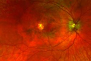 Xloseup of eye cells involved in new disease.