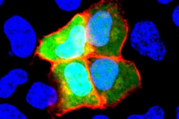 NCAM1 is induced only in green cells (HeLa cells). Serum from patients with anti-NCAM1 autoantibody react only to green cells (framed in red).
