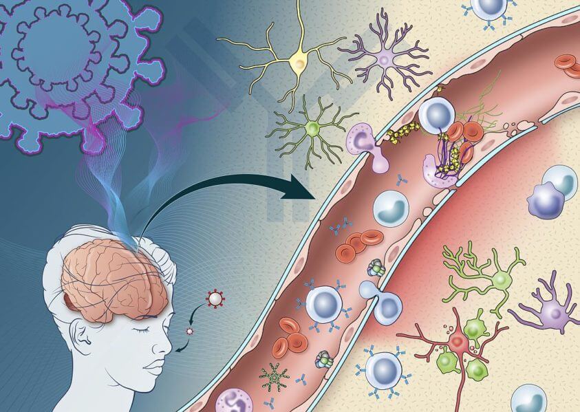 SARS-CoV-2 infection can trigger the production of immune molecules that damage cells lining blood vessels in the brain, causing platelets to stick together and form clots. Blood proteins also leak from the blood vessels, leading to inflammation and the destruction of neurons. NIH Medical Arts