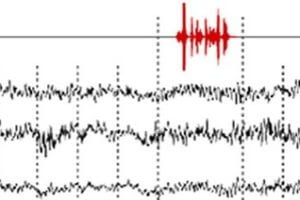 EEG reading of patient response to verbal commands to keep opening and closing hand (green) and stop opening and closing hand (red).