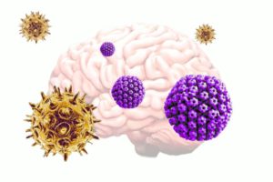 Varicella zoster virus (VZV), which commonly causes chickenpox and shingles, activates herpes simplex virus (HSV) from dormancy in neural tissue grown in vitro, which then leads to an increase in plaque deposits and decrease in neural signaling - hallmarks of Alzheimer's disease.
