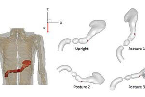 Diagram showing the original position of the stomach relative to the body and different relative positions of the stomach with respect to the direction of gravity considered in this study. CREDIT: Rajat Mittal