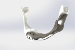 Netherlands Cancer Institute carried out first successful operation with custom 3D-printed titanium lower jaw