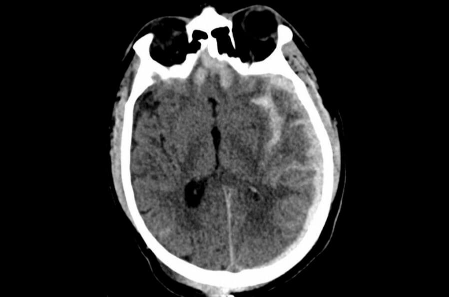 This CT scan shows serious brain injury. A simple blood test offers a more accurate prediction of whether the patient will die or survive with severe disabilities. Image provided by UCSF
