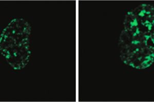 Left: Hutchinson-Gilford progeria syndrome cell with signs of premature aging. This cell shows less histone protein (green), which normally helps maintain the cell’s DNA integrity and function. Right: The cell shows less signs of aging when LINE-1 RNA is reduced, and there is more histone protein present.