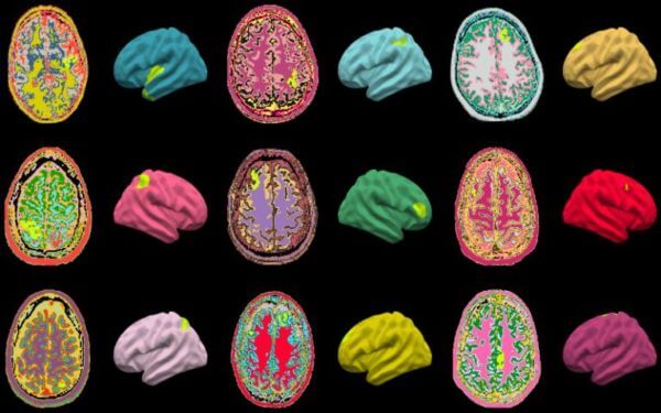 How old is your brain, really? AI accurately reflects risk of cognitive decline, Alzheimer’s based on brain age