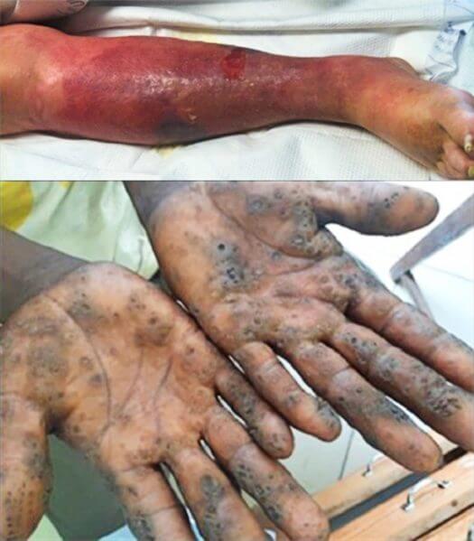 Top: Cellulitis of an extremity. Bottom: severe pitted keratolysis of the palms.