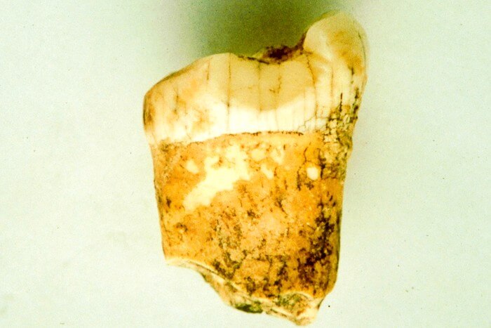 A first molar from a Neanderthal, analysed for this study.