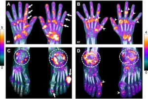 Pet scan of arthritic hands