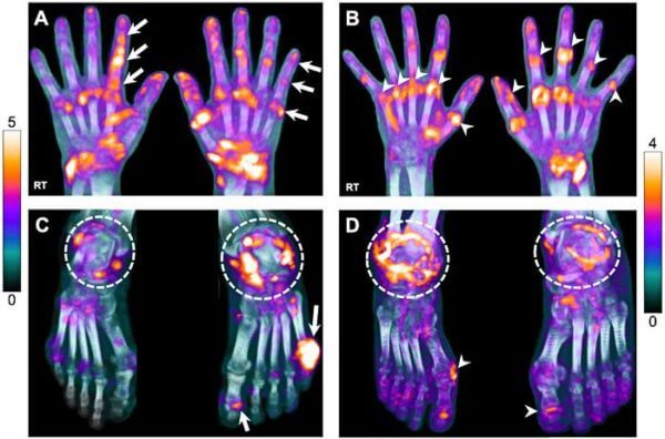 Common workplace fumes, dusts increase arthritis risk