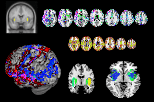 The brain’s claustrum activates when a person performs a complicated task.