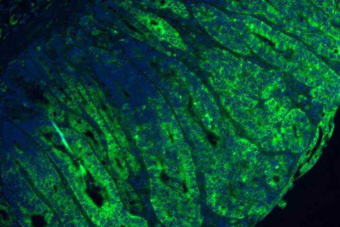 Green staining shows mTORC1 is significantly increased due to disruption in GATOR1 in a mouse model of colon cancer.