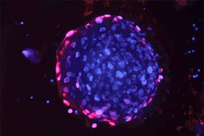 prostate cancer organoid, a small 3D structure that serves as a model of prostate tumors
