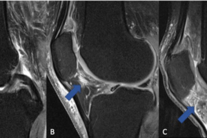 The fat pad adjacent to the kneecap (Hoffa's fat pad, infrapatellar fat pad) can change in signal on MRI when the knee is inflamed. (A) Normal knee without signs of inflammation. (B) Arrow pointing on a circumscribed area with higher signal (bright lines) in the area of the fat pad (normally dark), which is indicative of a beginning inflammatory reaction. (C) The whole fat pad has a higher signal (light grey color with white lines), which is a sign of progressive inflammation of the knee joint.