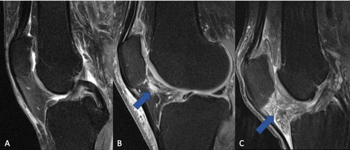 The fat pad adjacent to the kneecap (Hoffa's fat pad, infrapatellar fat pad) can change in signal on MRI when the knee is inflamed. (A) Normal knee without signs of inflammation. (B) Arrow pointing on a circumscribed area with higher signal (bright lines) in the area of the fat pad (normally dark), which is indicative of a beginning inflammatory reaction. (C) The whole fat pad has a higher signal (light grey color with white lines), which is a sign of progressive inflammation of the knee joint.