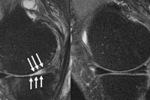 Knee joint of a patient showing (A) severe cartilage defects and (B) intact knee joint.