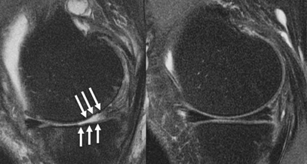 Knee joint of a patient showing (A) severe cartilage defects and (B) intac...                    </div>

                    <div class=