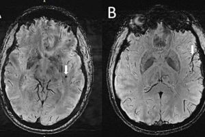 (A) Cerebral microbleeds (CMB) visualized as round, dark lesions (arrow) on SWI sequence in the left temporal lobe in a migraine case with aura. (B) Asymmetry in the appearance of the cortical vessels is more prominent on the left side (arrow) ipsilateral to the CMB.