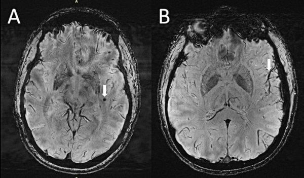 Ultra-high-res MRI reveals migraine brain changes