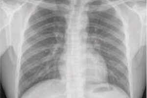 Normal chest X-ray