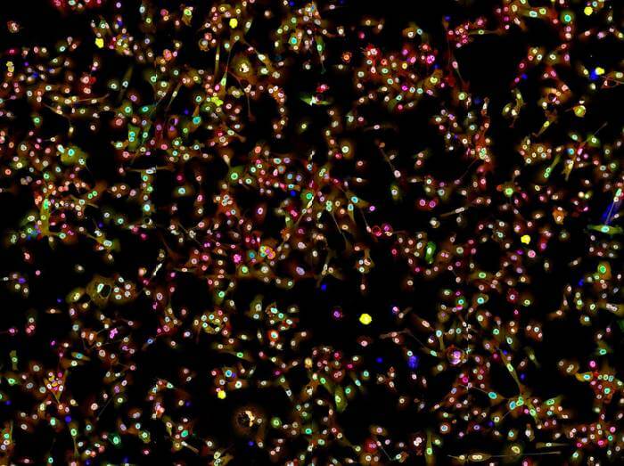 Fluorescence microscopy image of lung cancer cells stained with antibodies against proteins involved in cellular growth.