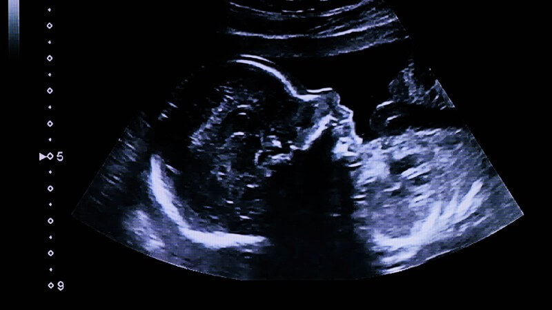 Fetal image in womb