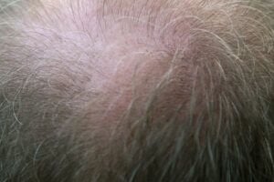 Close up of a man's balding head