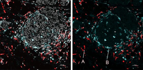 Image of human breast cancer cells showing A) immunosuppressive macrophages near tumor connective tissue, and B) immunostimulatory macrophages near tumor nests. Credit: Nir Ben Chetrit.