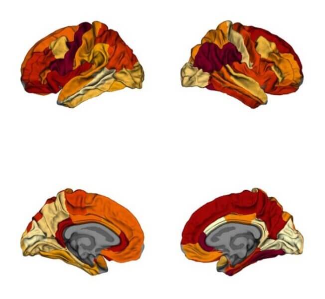 A comparison of cortical thickness between the brains of obese patients to those with Alzheimer’s disease. Darker colours indicate similarities in cortical thickness between the two groups.