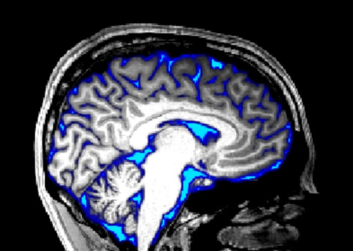 MRI image of adult brain, with regions of cerebrospinal fluid overlaid in blue.