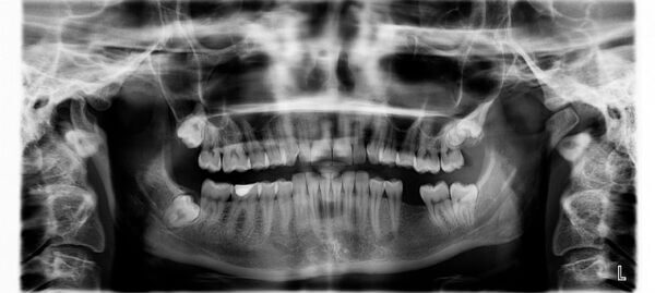 Dental xray of missing tooth