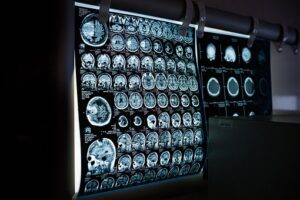 Xrays of a human skull