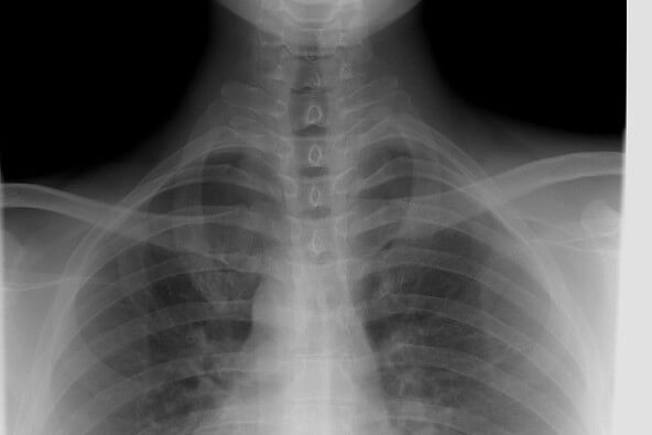 Spine xray