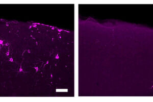 A new study presents evidence that 40 Hz vibration can reduce Alzheimer's disease pathology and symptoms in lab mice and improve their motor function. These images highlight reductions in the hallmark Alzheimer's disease protein phosphorylated tau (magenta) in primary somatosensory cortical neurons in Tau P301S model mice treated with 40 Hz tactile stimulation (right). An image from an untreated control is on the left.