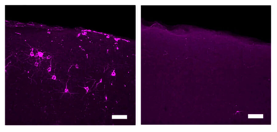 A new study presents evidence that 40 Hz vibration can reduce Alzheimer's disease pathology and symptoms in lab mice and improve their motor function. These images highlight reductions in the hallmark Alzheimer's disease protein phosphorylated tau (magenta) in primary somatosensory cortical neurons in Tau P301S model mice treated with 40 Hz tactile stimulation (right). An image from an untreated control is on the left.