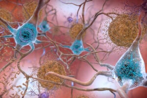 In the Alzheimer’s affected brain, abnormal collections of the tau protein accumulate and form tangles (seen in blue) within neurons, harming synaptic communication between nerve cells. Credits:Image: National Institute on Aging, NIH