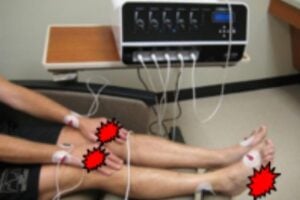 Scrambler therapy used for a patient with chemotherapy-induced peripheral neuropathy. The red bursts represent areas where the patient is experiencing pain.