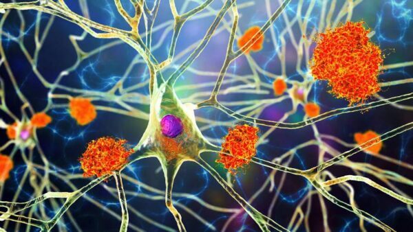 Study Unveils Shared Cellular Mechanisms in Major Dementias