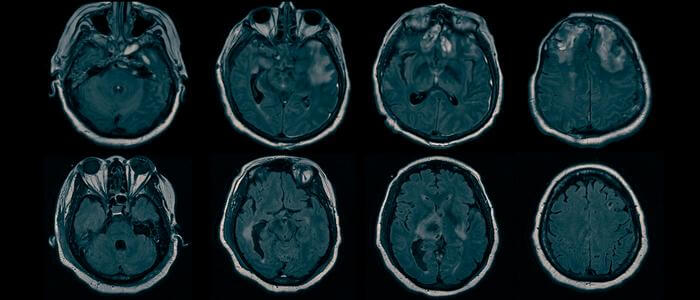 MRI scans reveal brain injuries underlying hidden consciousness.