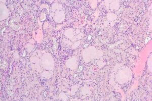 Squirrel kidney cells show signs of amyloid deposits