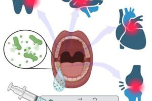 University of Cincinnati engineers have developed a test that uses saliva to warn consumers about periodontal disease, which if left untreated can lead to tooth loss, stroke, heart disease and other illnesses.