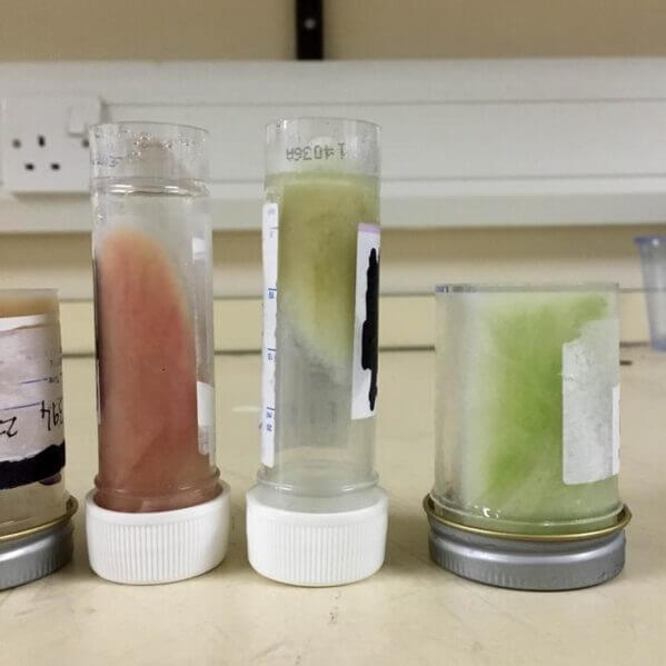 Different coloured sputum used as indicators of the degree of inflammation in the lungs