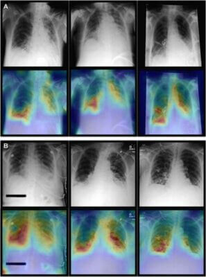 AI combines chest X-rays with patient data to improve diagnosis