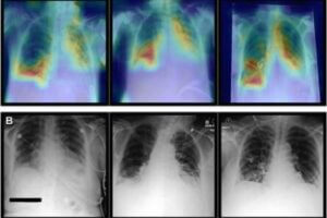 AI enhanced chest x ray