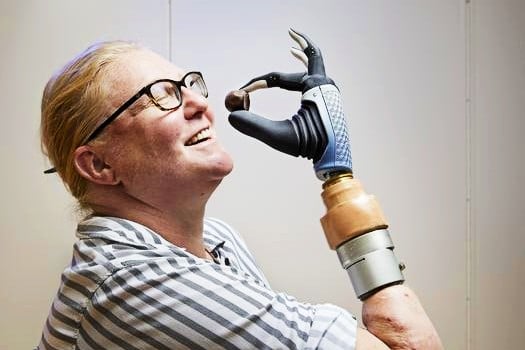 First person with a below-elbow amputation who received a bionic hand directly connected to her neuromusculoskeletal system