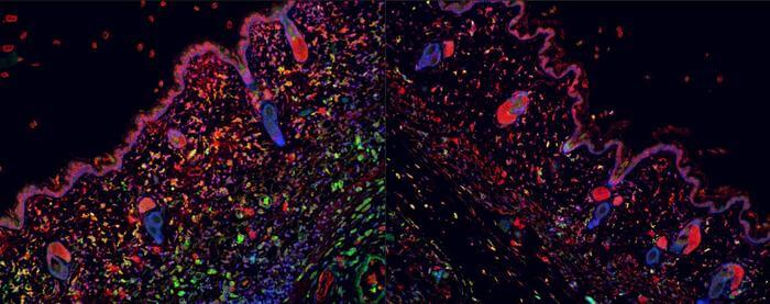 Image of intense inflammation in active lesion (left) and then after experimental treatment (right).