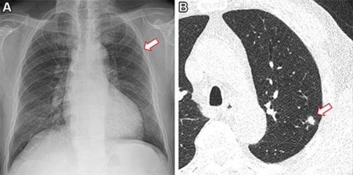 Frontal chest X-ray shows a small nodular opacity (arrow) in the left upper lung zone. Axial, non-contrast, low-dose chest CT scan shows a 9-mm solid nodule (arrow) in the left upper lobe.