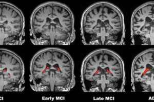 Brain MRI images.